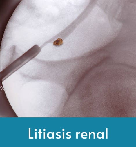 Litiasis renal